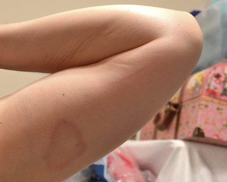 Granuloma annulare rash on my arm, Elizabeth Ruffing